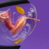 Papayacup menstruatiedisk 10 papaycup menstruatiedisk in vagina voorbeeld